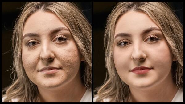 Montagem com 2 fotos da mesma mulher com marcas de espinha no rosto mostrando o antes e depois da edição do AirBrush