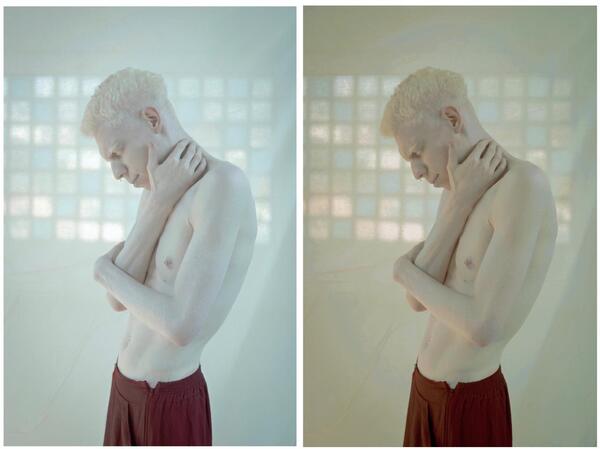 Homem albino com a mão no pescoço