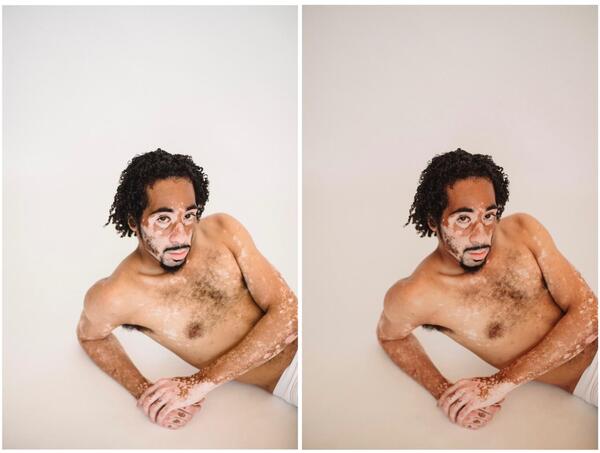 Homem negro com vitiligo apoiado no chão